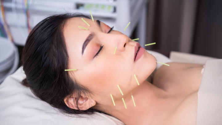 acupuncture